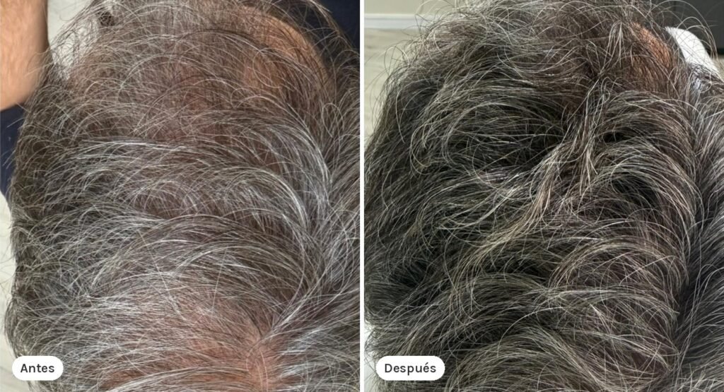 tessderma-unidad-capilar-caso-3