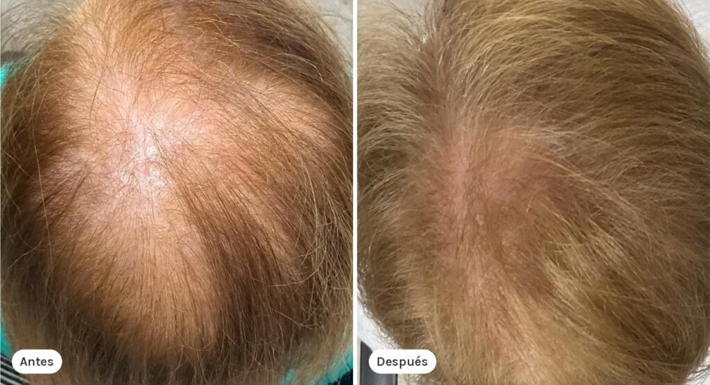 tessderma-unidad-capilar-caso-4